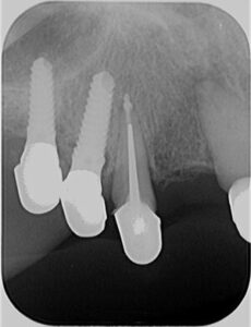Zahnarzt Oberursel Dr Mareike Buzello Endodontie Röntgenbild2